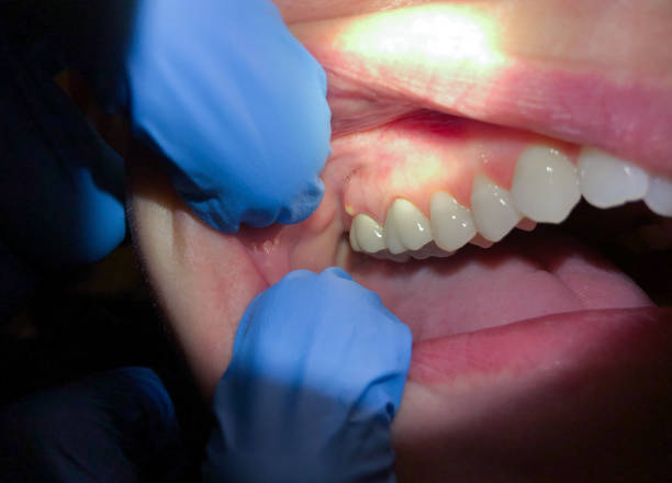 Best Emergency Root Canal Treatment in Flower Mound, TX